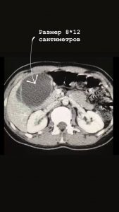 Раменские хирурги рассказали, чем может грозить употребление экзотической еды